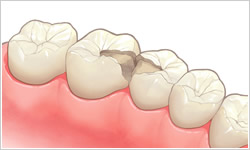 むし歯イメージ